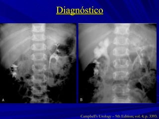 Diagnóstico Campbell’s Urology – 9th Edition; vol. 4; p. 3393. 