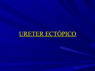 URETER ECTÓPICO 