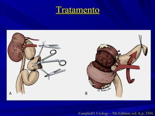 Tratamento Campbell’s Urology – 9th Edition; vol. 4; p. 3394. 