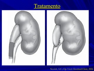 Tratamento Novick, A.C.; Op. Urol. Cleveland Clinic, 2006 