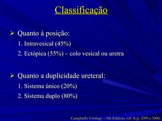 Classificação Quanto à posição: 1. Intravesical (45%) 2. Ectópica (55%) – colo vesical ou uretra Quanto a duplicidade ureteral: 1. Sistema único (20%) 2. Sistema duplo (80%) Campbell’s Urology – 9th Edition; vol. 4; p. 3399 e 3400. 