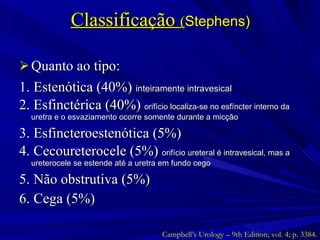 Classificação  ( Stephens) Quanto ao tipo: 1. Estenótica (40%)  inteiramente intravesical 2. Esfinctérica (40%)  orifício localiza-se no esfíncter interno da uretra e o esvaziamento ocorre somente durante a micção 3. Esfincteroestenótica (5%) 4. Cecoureterocele (5%)  orifício ureteral é intravesical, mas a ureterocele se estende até a uretra em fundo cego 5. Não obstrutiva (5%) 6. Cega (5%) Campbell’s Urology – 9th Edition; vol. 4; p. 3384. 