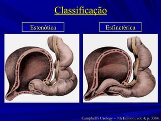 Classificação Estenótica Esfinctérica Campbell’s Urology – 9th Edition; vol. 4; p. 3384. 