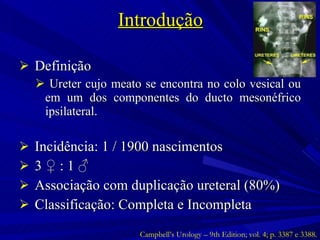 Introdução Definição Ureter cujo meato se encontra no colo vesical ou em um dos componentes do ducto mesonéfrico ipsilateral. Incidência: 1 / 1900 nascimentos 3  ♀  : 1  ♂ Associação com duplicação ureteral (80%) Classificação: Completa e Incompleta Campbell’s Urology – 9th Edition; vol. 4; p. 3387 e 3388. 