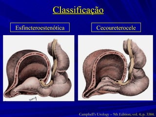 Classificação Esfincteroestenótica Cecoureterocele Campbell’s Urology – 9th Edition; vol. 4; p. 3384. 