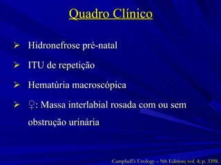 Quadro Clínico Hidronefrose pré-natal ITU de repetição Hematúria macroscópica ♀ : Massa interlabial rosada com ou sem obstrução urinária  Campbell’s Urology – 9th Edition; vol. 4; p. 3398. 