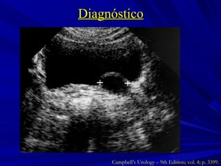 Diagnóstico Campbell’s Urology – 9th Edition; vol. 4; p. 3399. 