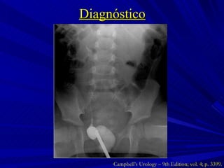 Diagnóstico Campbell’s Urology – 9th Edition; vol. 4; p. 3399. 