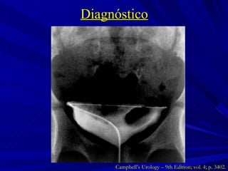 Diagnóstico Campbell’s Urology – 9th Edition; vol. 4; p. 3402. 