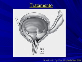 Tratamento Novick, A.C.; Op. Urol. Cleveland Clinic, 2006. 