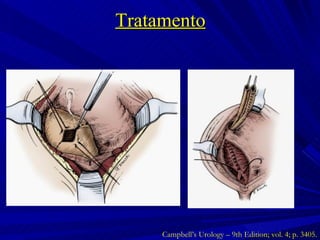 Tratamento Campbell’s Urology – 9th Edition; vol. 4; p. 3405. 