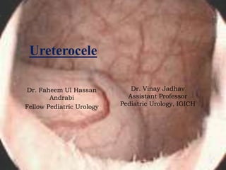 Ureterocele
Dr. Faheem Ul Hassan
Andrabi
Fellow Pediatric Urology
Dr. Vinay Jadhav
Assistant Professor
Pediatric Urology, IGICH
 