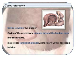 Cecoureterocele
• Orifice is within the bladder,
• Cavity of the ureterocele extends beyond the bladder neck
into the urethra.
• may create surgical challenges, particularly with endoscopic
incision
 