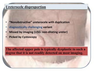 Ureterocele disproportion
• “Nonobstructive” ureterocele with duplication
• diagnostically challenging variant
• Missed by imaging (USG: non-dilating ureter)
• Picked by Cystoscopy
The affected upper pole is typically dysplastic to such a
degree that it is not readily detected on most imaging.
 