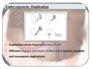 Embryogenesis- Duplication
• Duplication arises from bifurcation of UB
• Different degrees and levels of bifurcation lead to complete
and incomplete duplications
 