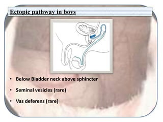 Ectopic pathway in boys
• Below Bladder neck above sphincter
• Seminal vesicles (rare)
• Vas deferens (rare)
 
