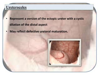 Ureteroceles
• Represent a version of the ectopic ureter with a cystic
dilation of the distal aspect
• May reflect defective ureteral maturation.
 