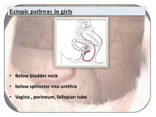 Ectopic pathway in girls
• Below bladder neck
• below sphincter into urethra
• Vagina , perineum, fallopian tube
 