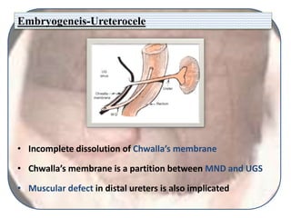 Embryogeneis-Ureterocele
• Incomplete dissolution of Chwalla’s membrane
• Chwalla’s membrane is a partition between MND and UGS
• Muscular defect in distal ureters is also implicated
 