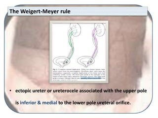 The Weigert-Meyer rule
• ectopic ureter or ureterocele associated with the upper pole
is inferior & medial to the lower pole ureteral orifice.
 