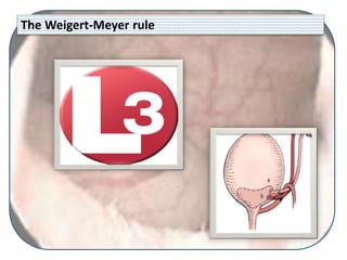 The Weigert-Meyer rule
 