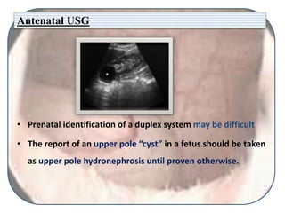 Antenatal USG
• Prenatal identification of a duplex system may be difficult
• The report of an upper pole “cyst” in a fetus should be taken
as upper pole hydronephrosis until proven otherwise.
 