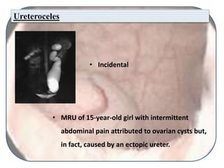 Ureteroceles
• MRU of 15-year-old girl with intermittent
abdominal pain attributed to ovarian cysts but,
in fact, caused by an ectopic ureter.
• Incidental
 