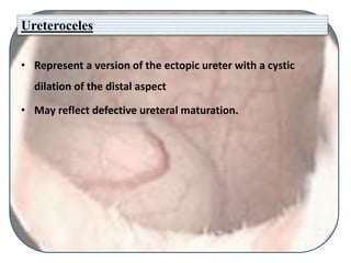 Ureteroceles
• Represent a version of the ectopic ureter with a cystic
dilation of the distal aspect
• May reflect defective ureteral maturation.
 