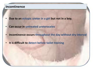 Incontinence
• Due to an ectopic ureter in a girl but not in a boy.
• Can occur in untreated ureteroceles
• Incontinence occurs throughout the day without dry interval
• It is difficult to detect before toilet training
 