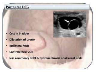 Postnatal USG
• Cyst in bladder
• Dilatation of ureter
• Ipsilateral VUR
• Contralateral VUR
• less commonly BOO & hydronephrosis of all renal units
 
