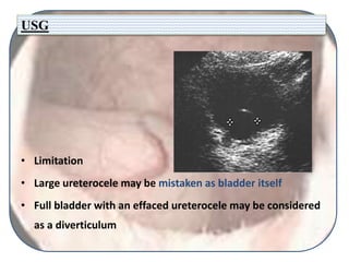 USG
• Limitation
• Large ureterocele may be mistaken as bladder itself
• Full bladder with an effaced ureterocele may be considered
as a diverticulum
 