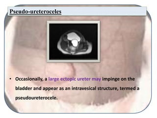 Pseudo-ureteroceles
• Occasionally, a large ectopic ureter may impinge on the
bladder and appear as an intravesical structure, termed a
pseudoureterocele.
 