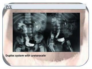 IVU
Duplex system with ureterocele
 