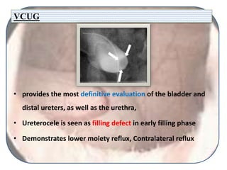 VCUG
• provides the most definitive evaluation of the bladder and
distal ureters, as well as the urethra,
• Ureterocele is seen as filling defect in early filling phase
• Demonstrates lower moiety reflux, Contralateral reflux
 