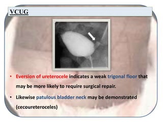 VCUG
• Eversion of ureterocele indicates a weak trigonal floor that
may be more likely to require surgical repair.
• Likewise patulous bladder neck may be demonstrated
(cecoureteroceles)
 