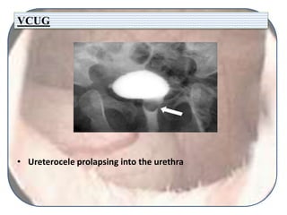 VCUG
• Ureterocele prolapsing into the urethra
 