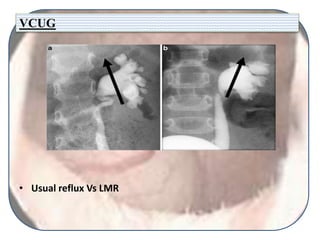 VCUG
• Usual reflux Vs LMR
 