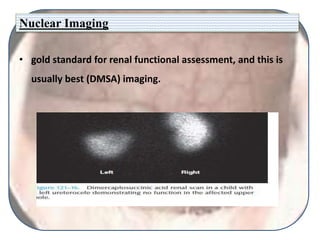 Nuclear Imaging
• gold standard for renal functional assessment, and this is
usually best (DMSA) imaging.
 