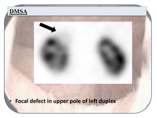 DMSA
• Focal defect in upper pole of left duplex
 