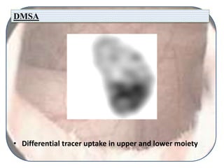DMSA
• Differential tracer uptake in upper and lower moiety
 