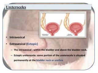 Ureteroceles
• Intravesical
• Extravesical (Ectopic)
– The intravesical : within the bladder and above the bladder neck.
– Ectopic ureterocele: some portion of the ureterocele is situated
permanently at the bladder neck or urethra
 