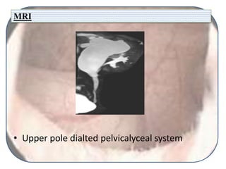 MRI
• Upper pole dialted pelvicalyceal system
 