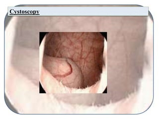 Cystoscopy
 