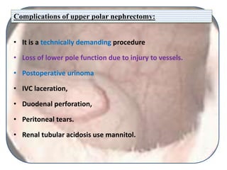 Complications of upper polar nephrectomy:
• It is a technically demanding procedure
• Loss of lower pole function due to injury to vessels.
• Postoperative urinoma
• IVC laceration,
• Duodenal perforation,
• Peritoneal tears.
• Renal tubular acidosis use mannitol.
 