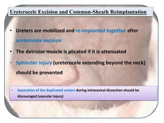 Ureterocele Excision and Common-Sheath Reimplantation
• Ureters are mobilized and re-implanted together after
ureterocele excision
• The detrusor muscle is plicated if it is attenuated
• Sphincter injury (ureterocele extending beyond the neck)
should be prevented
• Separation of the duplicated ureters during intravesical dissection should be
discouraged (vascular injury)
 