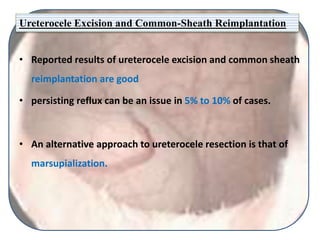 Ureterocele Excision and Common-Sheath Reimplantation
• Reported results of ureterocele excision and common sheath
reimplantation are good
• persisting reflux can be an issue in 5% to 10% of cases.
• An alternative approach to ureterocele resection is that of
marsupialization.
 
