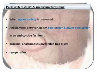 Pyeloureterostomy & ureteroureterostomy
• When upper moiety is preserved
• Anastomosis between upper pole ureter & lower pole ureter
in an end-to-side fashion. .
• proximal anastomoses preferable to a distal
• (yo-yo reflux)
 