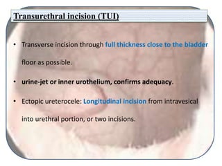 Transurethral incision (TUI)
• Transverse incision through full thickness close to the bladder
floor as possible.
• urine-jet or inner urothelium, confirms adequacy.
• Ectopic ureterocele: Longitudinal incision from intravesical
into urethral portion, or two incisions.
 