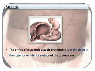 Stenotic
• The orifice of a stenotic ectopic ureterocele is at the tip or at
the superior or inferior surface of the ureterocele
 