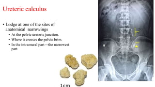 Ureteric calculus
• Lodge at one of the sites of
anatomical narrowings
• At the pelvic ureteric junction.
• Where it crosses the pelvic brim.
• In the intramural part—the narrowest
part
 